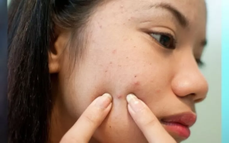 Acneea se poate vindeca prin puterea mintii