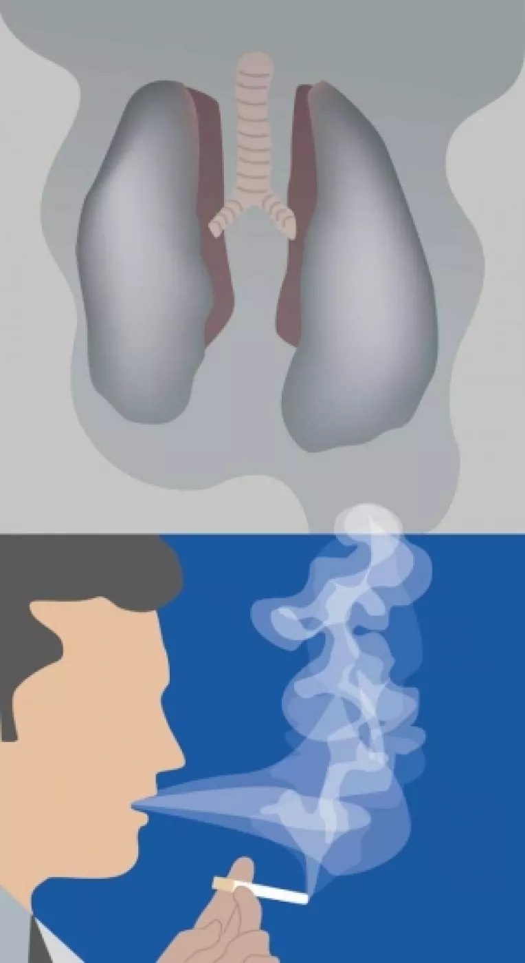 Cancerele pulmonare si cele renale sunt descoperite in ultimele stadii