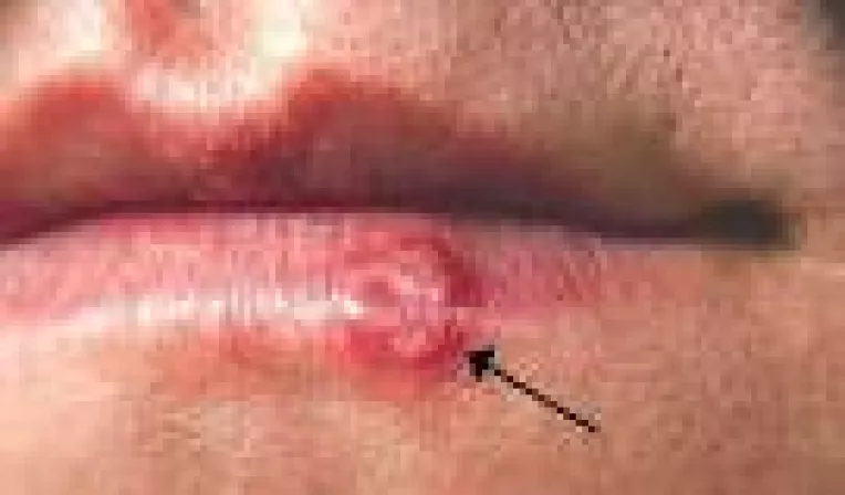 Cauza aparitiei virusului herpesului este virusul herpes simplex 