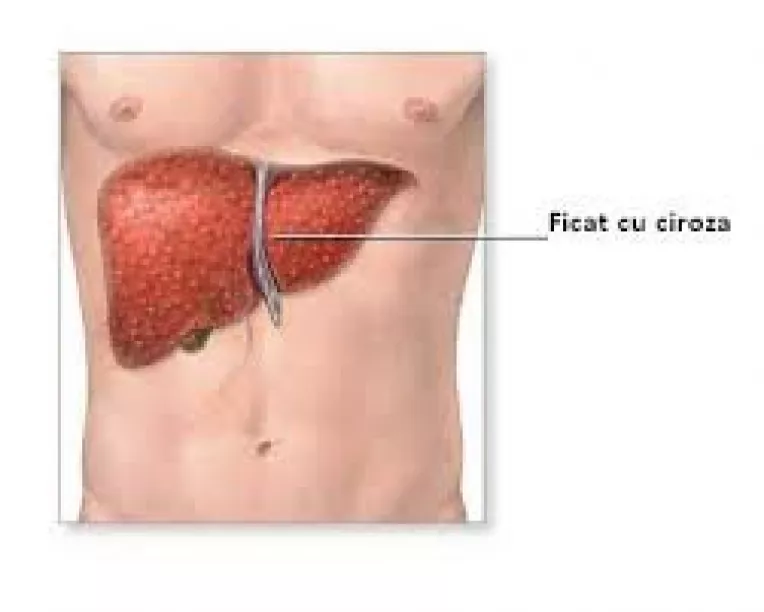Cauzele aparitiei cirozei