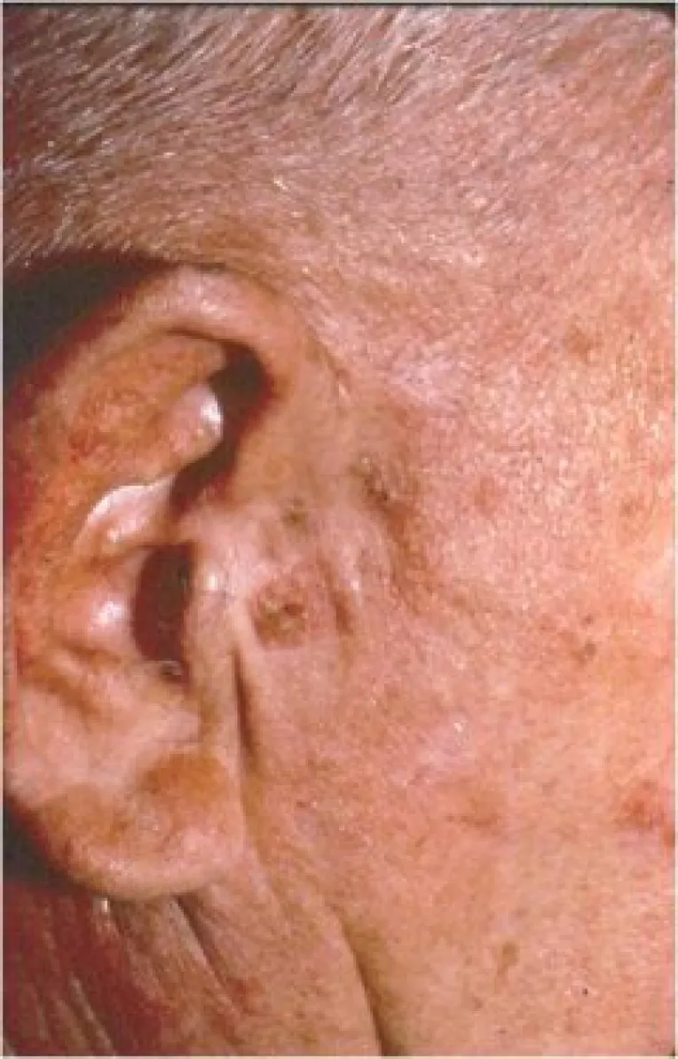 Keratoza actinica, leziune precanceroasa a pielii, cunoscuta si sub numele de keratoza solara (2)