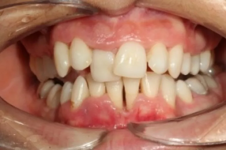 Malocluzia, o deviatie de la ocluzia normala a dintilor