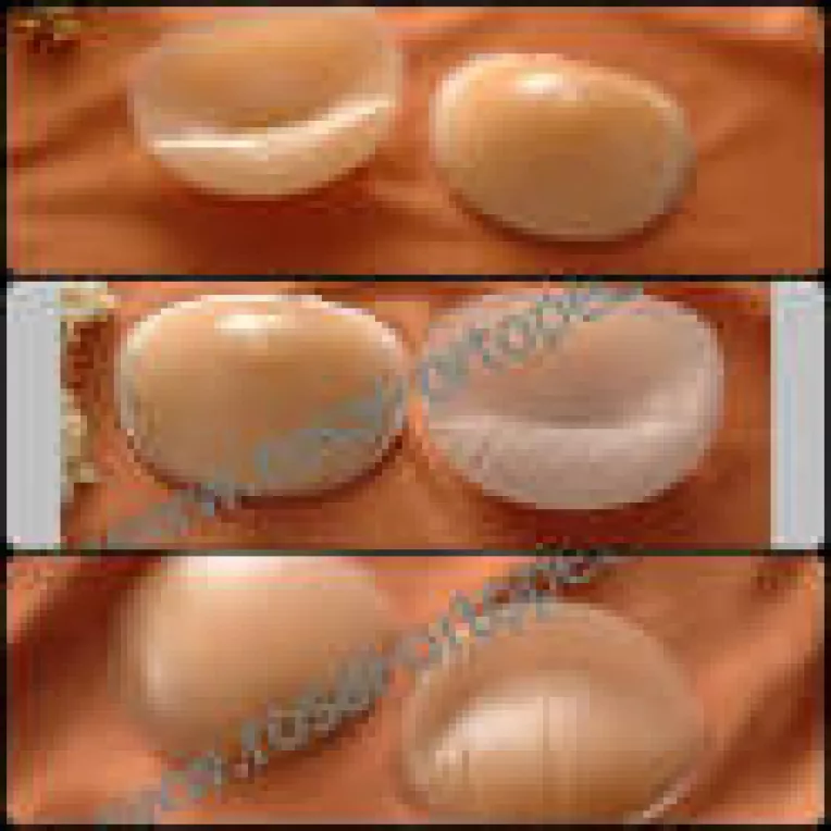 Protezele externe: o solutie pentru femeile operate de cancer de san 
