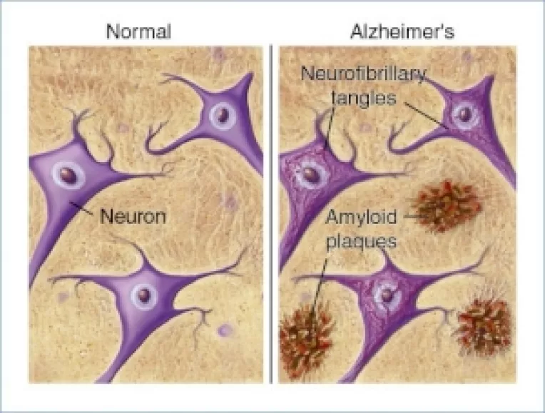 Simptome ale bolii Alzheimer