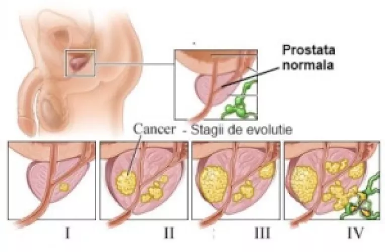 Studiu: Estrogenii administrati sub forma de plasture cutanat combat cancerul de prostata